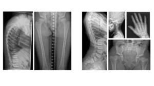 How a Gene Mutation in Matrix Gla Protein Causes Spondyloepiphyseal Dysplasia: A Study by McGill Researchers