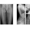 How a Gene Mutation in Matrix Gla Protein Causes Spondyloepiphyseal Dysplasia: A Study by McGill Researchers
